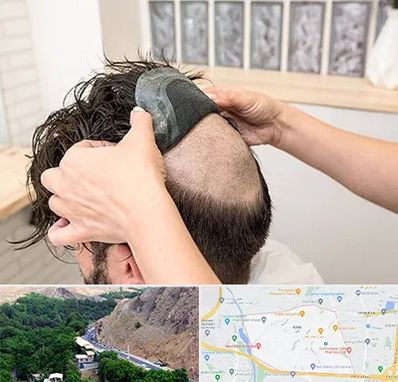 پروتز مو در کن 