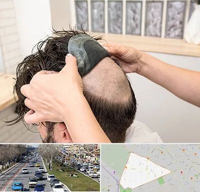 پروتز مو در احمدآباد مشهد 