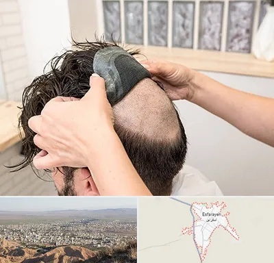 پروتز مو در اسفراین