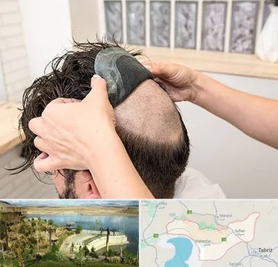 پروتز مو در شبستر