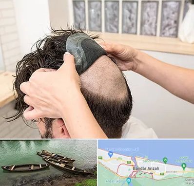 پروتز مو در بندر انزلی