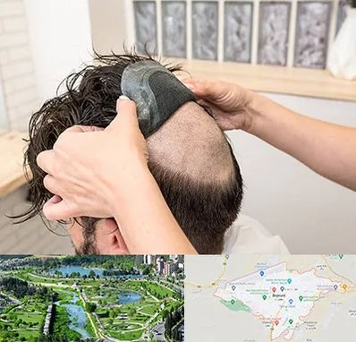 پروتز مو در بجنورد