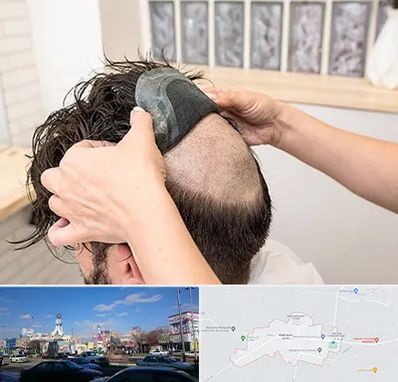 پروتز مو در ماهدشت کرج 