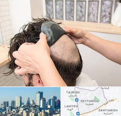 پروتز مو در قیطریه 