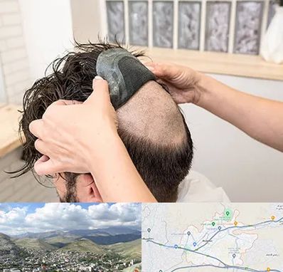 پروتز مو در رودهن