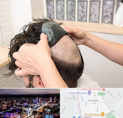 پروتز مو در گلسار رشت 