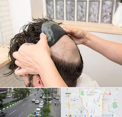 پروتز مو در ستارخان 