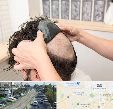 پروتز مو در جنوب تهران 