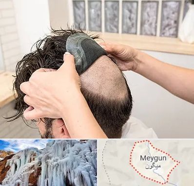 پروتز مو در میگون