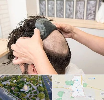 پروتز مو در کاشمر