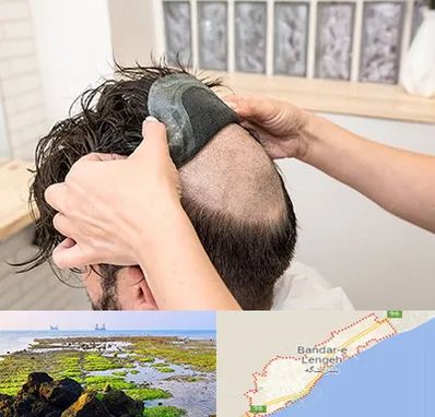 پروتز مو در بندرلنگه