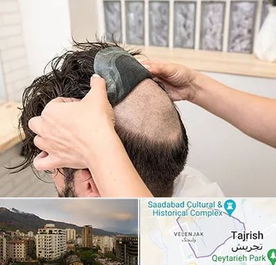 پروتز مو در زعفرانیه 