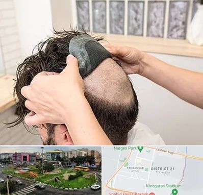 پروتز مو در تهرانسر 