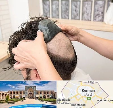 پروتز مو در کرمان