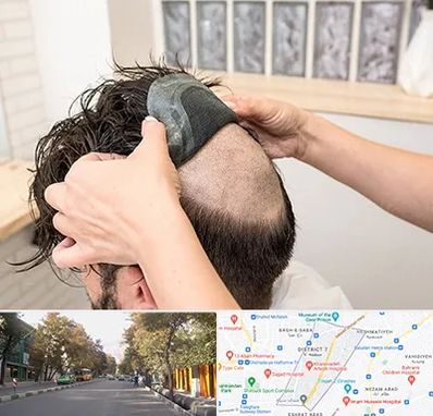 پروتز مو در شریعتی 