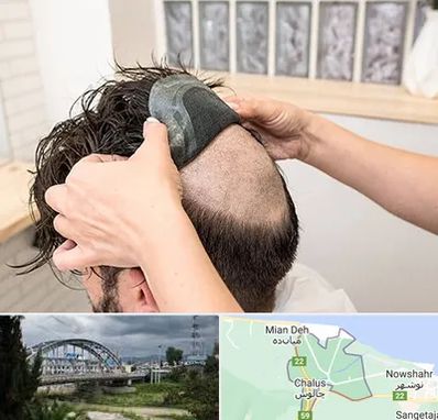 پروتز مو در چالوس