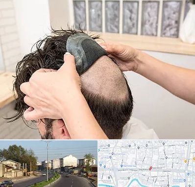 پروتز مو در ضیابری رشت 