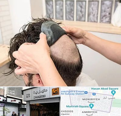 پروتز مو در منیریه 