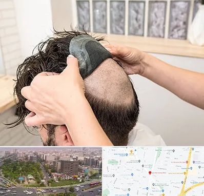 پروتز مو در آیت الله کاشانی 