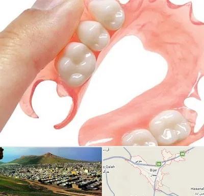 پروتز متحرک دندان در بیجار