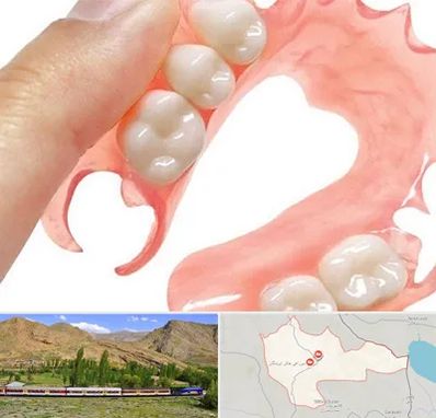 پروتز متحرک دندان در خاش