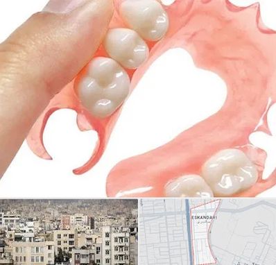 پروتز متحرک دندان در اسکندری