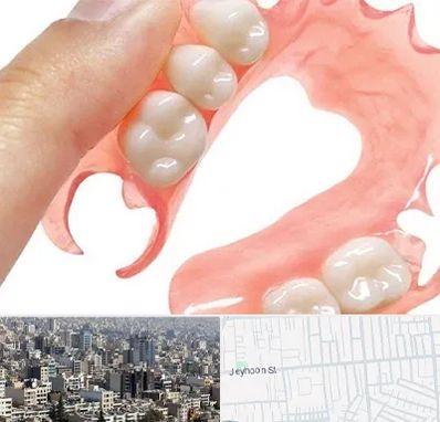 پروتز متحرک دندان در جیحون
