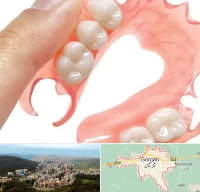 پروتز متحرک دندان در گرگان