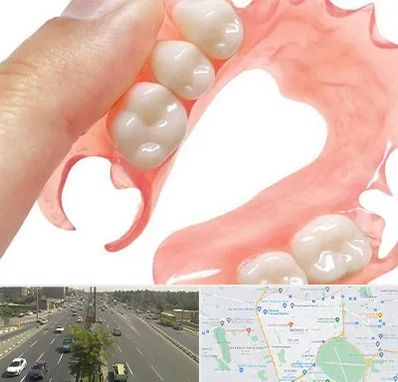 پروتز متحرک دندان در منطقه 17 تهران 