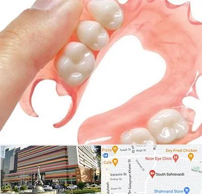 پروتز متحرک دندان در سهروردی 