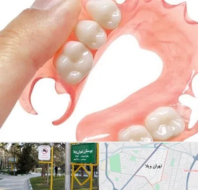 پروتز متحرک دندان در تهران ویلا