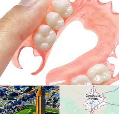 پروتز متحرک دندان در گنبد کاووس