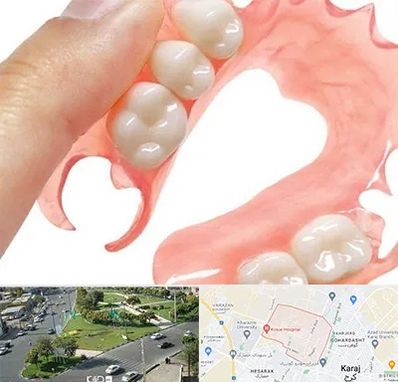 پروتز متحرک دندان در شاهین ویلا کرج 