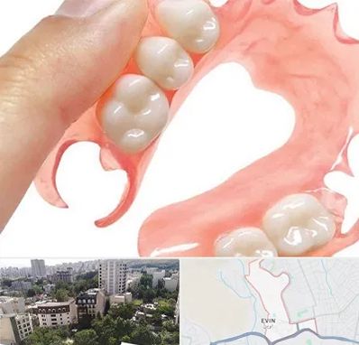 پروتز متحرک دندان در اوین