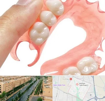 پروتز متحرک دندان در فاز سه اندیشه
