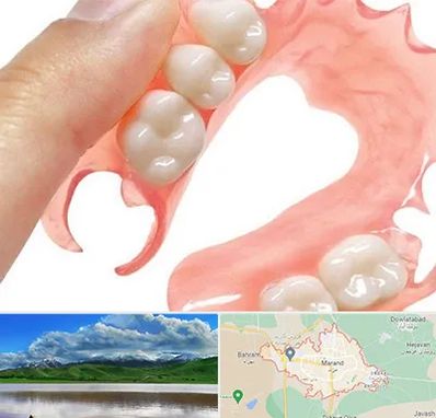 پروتز متحرک دندان در مرند