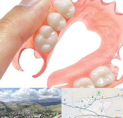 پروتز متحرک دندان در رودهن