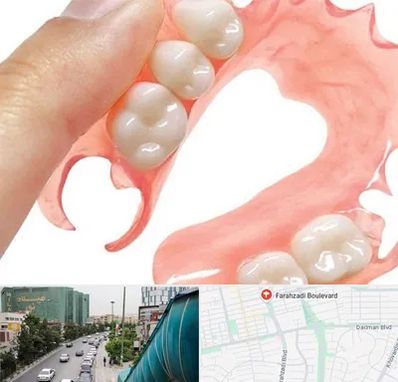 پروتز متحرک دندان در بلوار فرحزادی