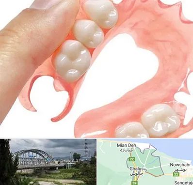پروتز متحرک دندان در چالوس