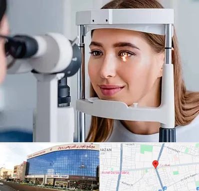 دکتر قوز قرنیه در نصف راه تبریز
