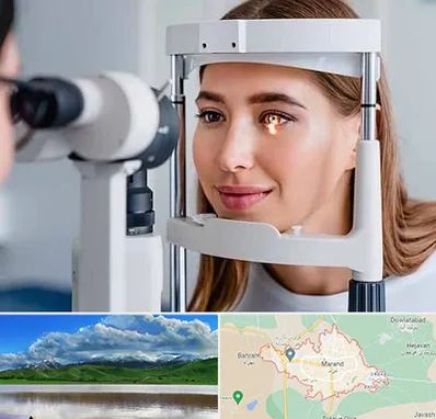 دکتر قوز قرنیه در مرند