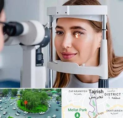 دکتر قوز قرنیه در تجریش