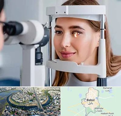 دکتر قوز قرنیه در بابل