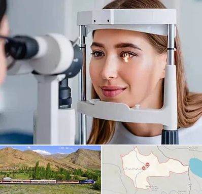 دکتر قوز قرنیه در خاش