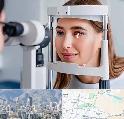 دکتر قوز قرنیه در شمال شرق تهران