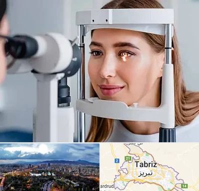 دکتر قوز قرنیه در تبریز