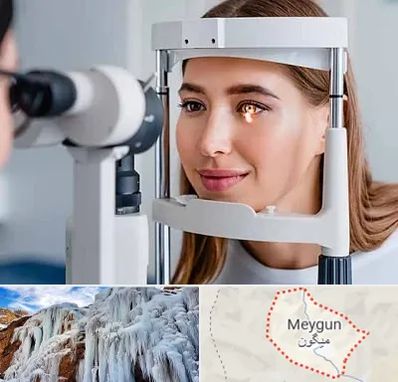 دکتر قوز قرنیه در میگون
