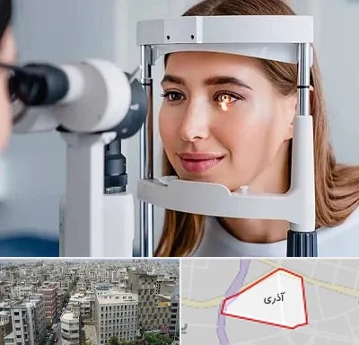 دکتر قوز قرنیه در آذری