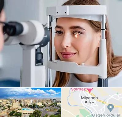 دکتر قوز قرنیه در میانه