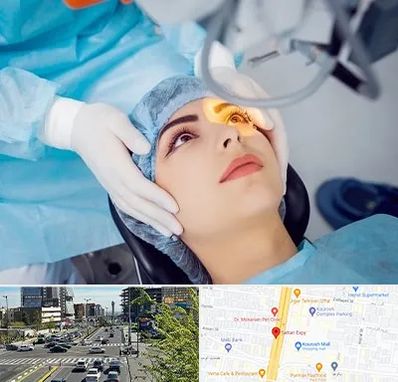 دکتر عمل لیزیک چشم در ستاری